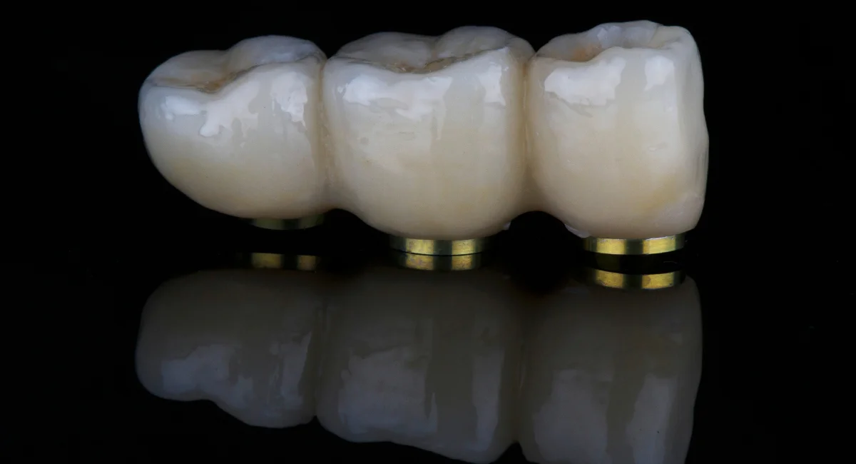 Was ist Teleskopprothese, im Oberkiefer, im Unterkiefer, Nachteile und mehr